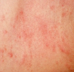 Eczema And Dry Skin